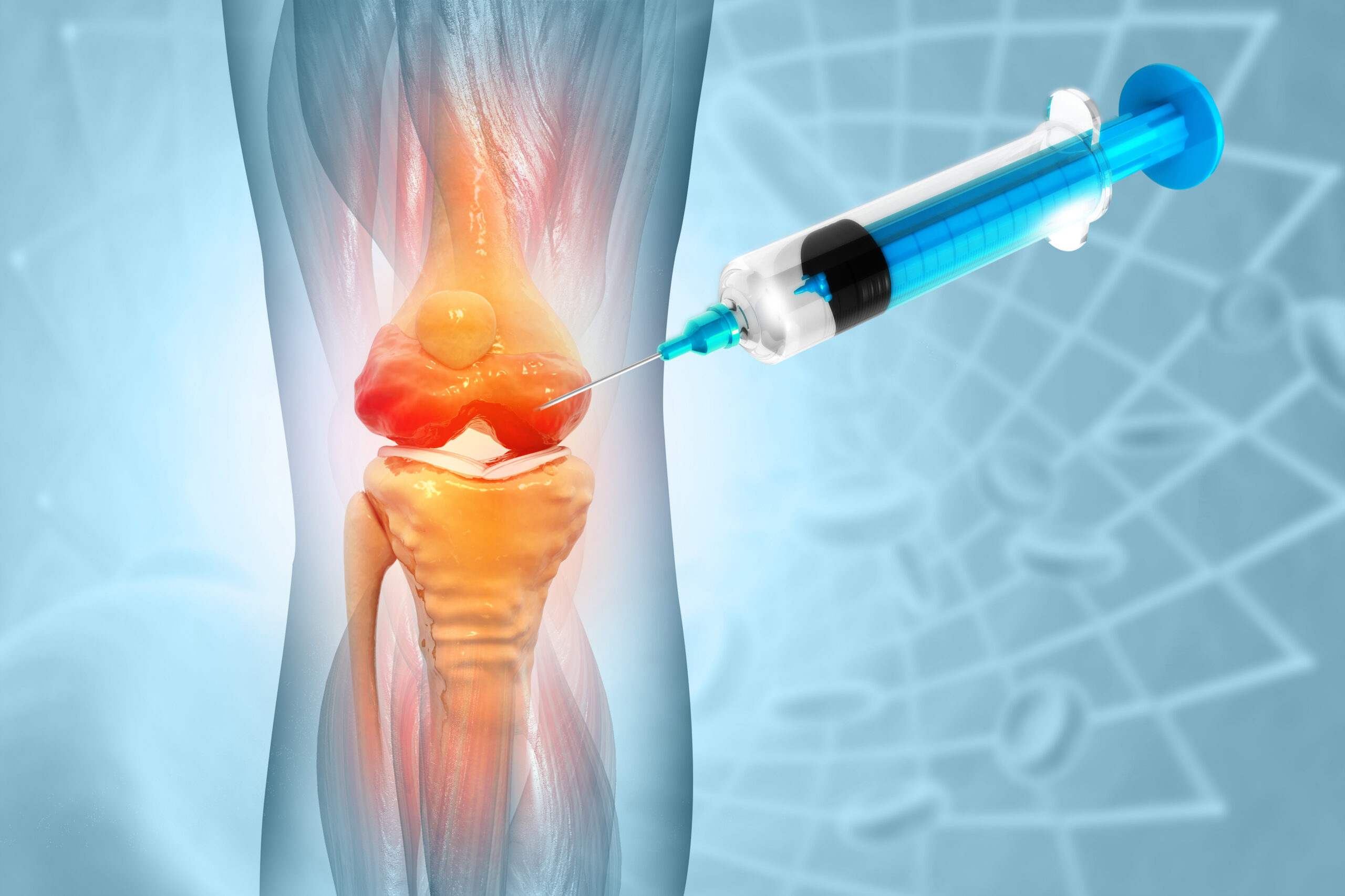 Hymovis A New Injection to Ease Knee Pain - Advantage Orthopedic and Sports Medicine Hymovis A New Injection to Ease Knee Pain - Advantage Orthopedic and Sports Medicine